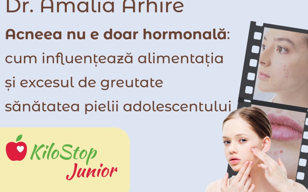 Acneea la adolescenți: cum influențează alimentația și excesul de greutate sănătatea pielii